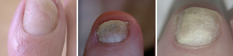fungal-nail-diagnosis-bradford