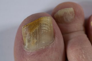 fungal-nail-laser-treatment