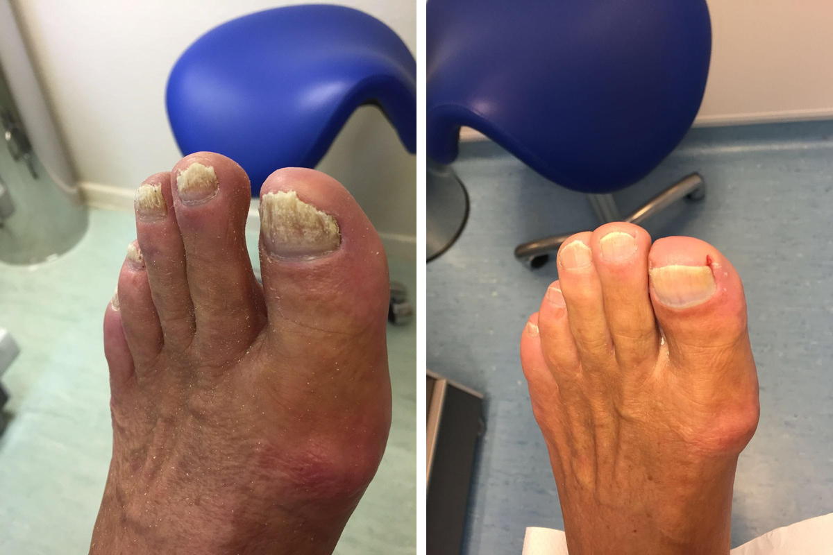 Fungal Nail Success Stories Chiropody Feet First